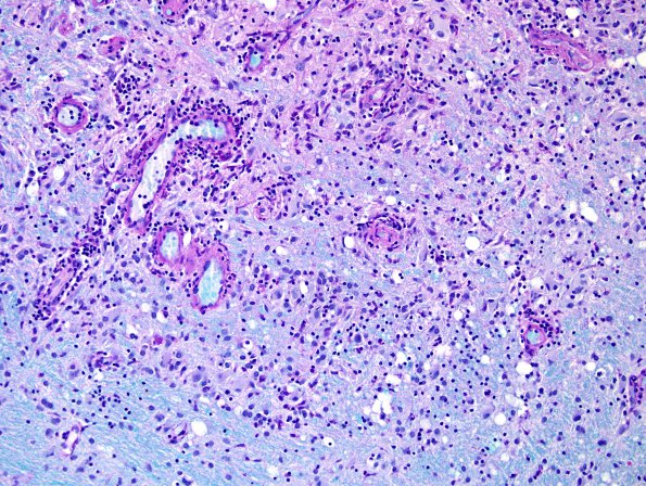 2C3 Sentinel Lesion (Case 2 - 1st Bx) area B LFB-PAS 5