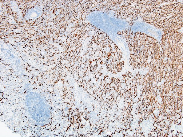 2D1 Sentinel Lesion (Case 2 - 1st Bx) area A NF 10X