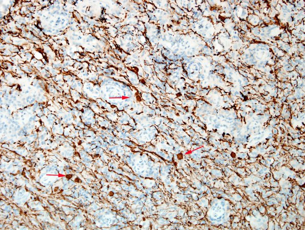 2D3 Sentinel Lesion (Case 2 - 1st Bx) area B NF 1 copy