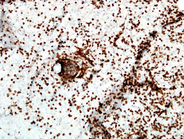 2F2 Sentinel Lesion (Case 2 - 1st Bx) CD3 1