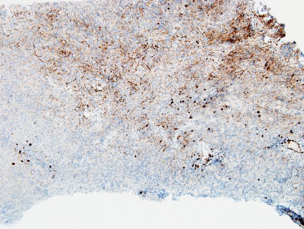 2G1 Sentinel Lesion (Case 2 - 1st Bx) area B CD20 10X 2