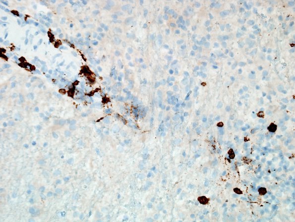 2G2 Sentinel Lesion (Case 2 - 1st Bx) CD20 1