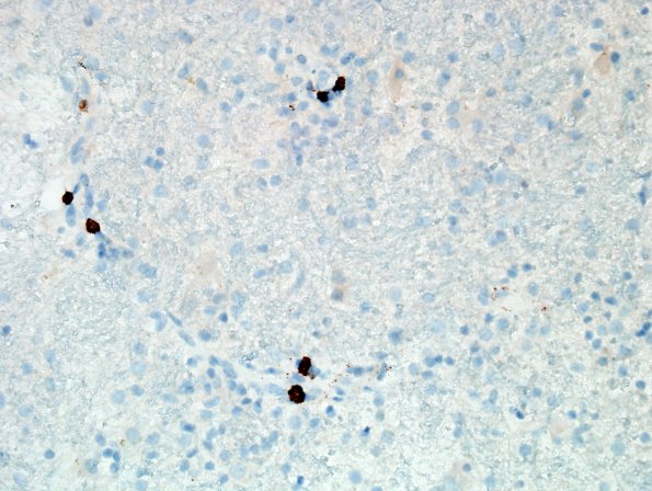 2G4 Sentinel Lesion (Case 2 - 1st Bx) CD20 9