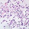 2J5 Sentinel Lesion (Case 2 - 1st Bx) smear H&E 2 A