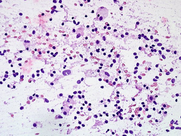 2J5 Sentinel Lesion (Case 2 - 1st Bx) smear H&E 2 A