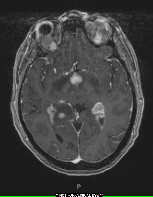 2L Sentinel Lesion (Case 2 - 2nd Bx) T1W 1 - Copy - Copy