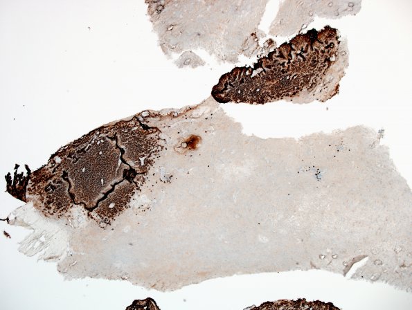 2N1 Sentinel Lesion (Case 2 - 2nd Bx) CD20 5