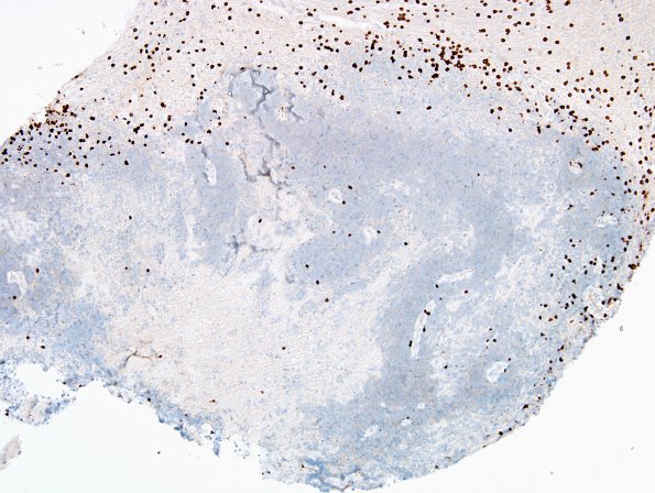 2R2 Sentinel Lesion (Case 2 - 2nd Bx) CD3 7