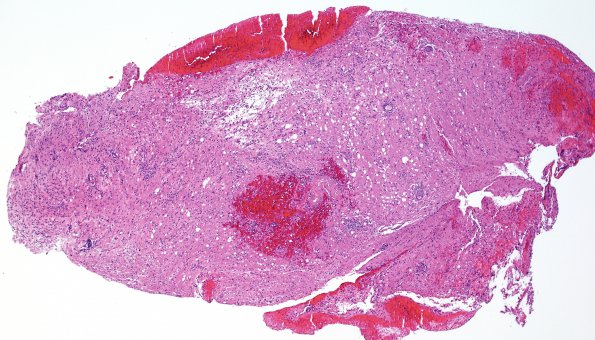 3A1 Sentinel Lesion (Case 3 - 1st Bx) H&E 4X