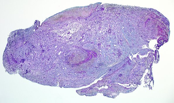 3B1 Sentinel Lesion (Case 3 - 1st Bx) LFB-PAS 4X