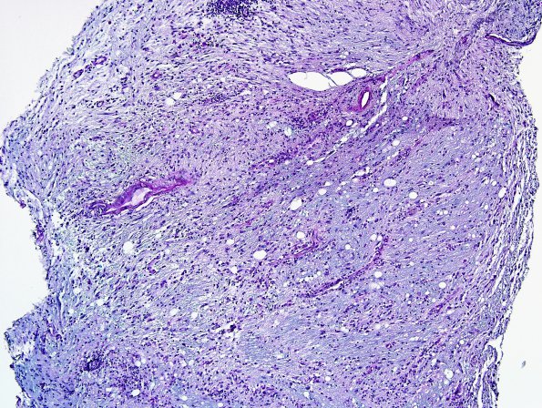 3B2 Sentinel Lesion (Case 3 - 1st Bx) LFB-PAS 10X B