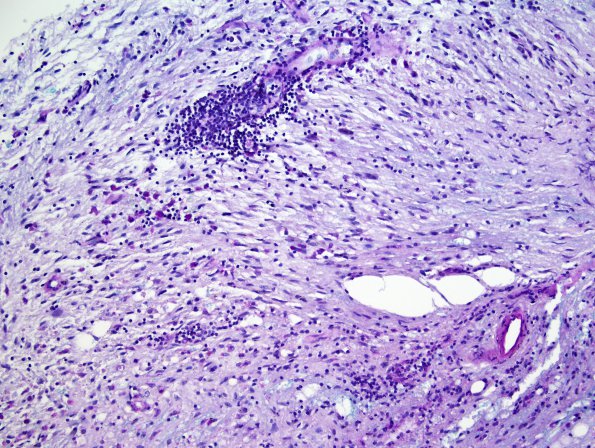 3B3 Sentinel Lesion (Case 3 - 1st Bx) LFB-PAS 5