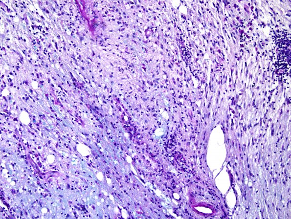 3B5 Sentinel Lesion (Case 3 - 1st Bx) LFB-PAS area C 20X