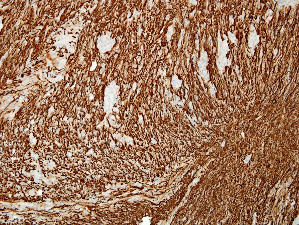 3C3 Sentinel Lesion (Case 3 - 1st Bx) NF 6