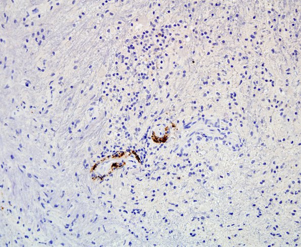 3D2 Sentinel Lesion (Case 3 - 1st Bx) CD20 7