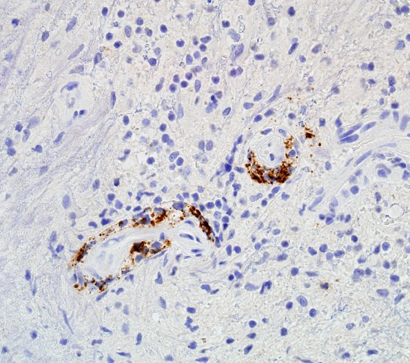 3D3 Sentinel Lesion (Case 3 - 1st Bx) CD20 4