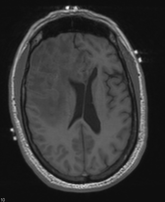 4A1 Lymphoma, B cell & sentinel (Case 4) T1 - Copy