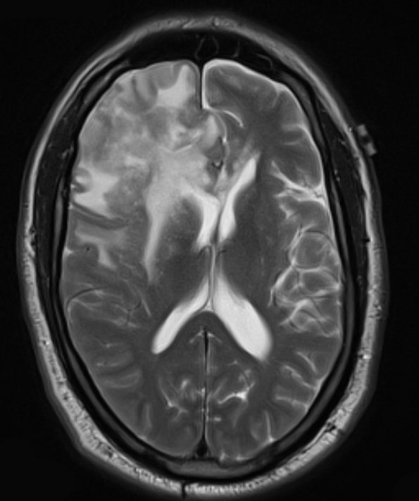 4A3 Lymphoma, B cell & sentinel (Case 4) T2 W 3 - Copy