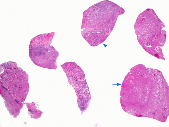 4B1 Lymphoma, B cell & sentinel (Case 4) 2X H&E copy