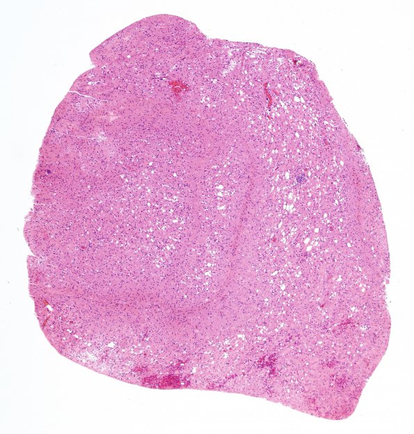 4B2 Lymphoma, B cell & sentinel (Case 4) demyelinated area 4X H&E