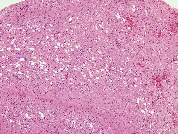 4B3 Lymphoma, B cell & sentinel (Case 4) demyelinated area H&E 3