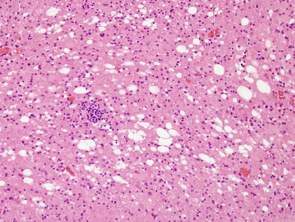 4B4 Lymphoma, B cell & sentinel (Case 4) demyelinated area H&E 1