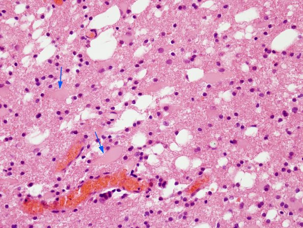 4B5 Lymphoma, B cell & sentinel (Case 4) demyelinated area H&E 2 copy