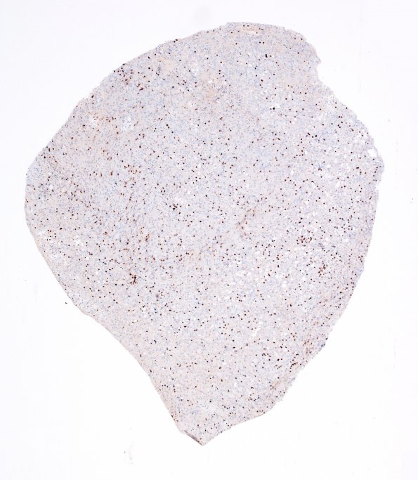 4C2 Lymphoma, B cell & sentinel (Case 4) demyelinated area 4X CD3