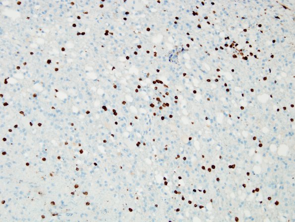 4C3 Lymphoma, B cell & sentinel (Case 4) demyelinated area CD3 1