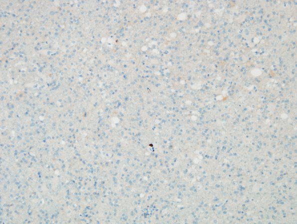 4C6 Lymphoma, B cell & sentinel (Case 4) demyelinated area CD20 2