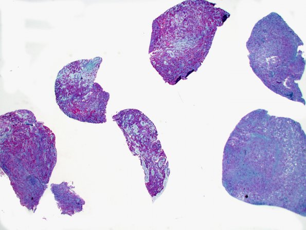 4D1 Lymphoma, B cell & sentinel (Case 4) X CD68 (red)