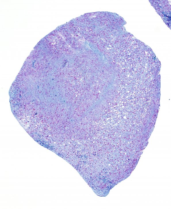 4D2 Lymphoma, B cell & sentinel (Case 4) demyelinated area 4X CD68 red