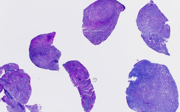 4E1 Lymphoma, B cell & sentinel (Case 4) 2X LFB-PAS