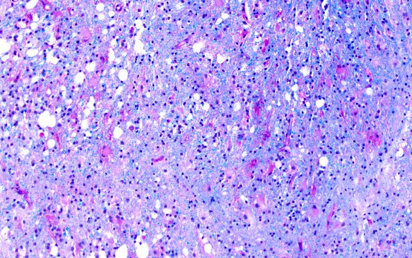 4E4 Lymphoma, B cell & sentinel (Case 4) demyelinated area LFB-PAS A3