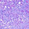 4E5 Lymphoma, B cell & sentinel (Case 4) demyelinated area LFB-PAS A1