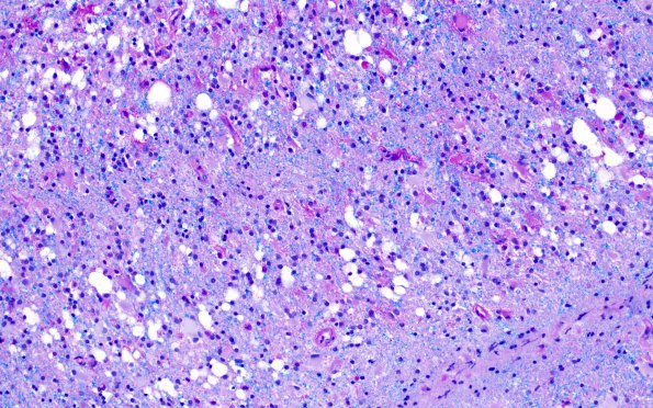 4E5 Lymphoma, B cell & sentinel (Case 4) demyelinated area LFB-PAS A1