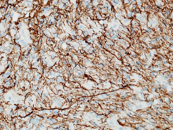 4F4 Lymphoma, B cell & sentinel (Case 4) demyelinated area NF 2