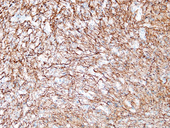 4F5 Lymphoma, B cell & sentinel (Case 4) demyelinated area NF 4