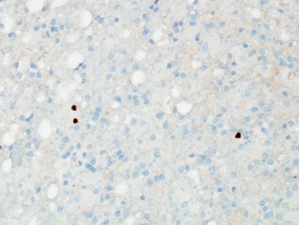 4H3 Lymphoma, B cell & sentinel (Case 4) demyelinated area Ki67 1