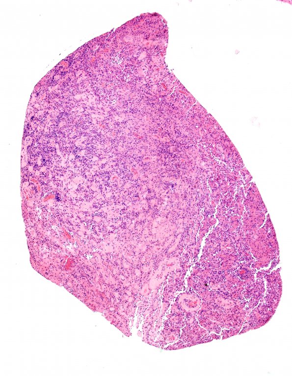 4J1 Lymphoma, B cell & sentinel (Case 4) neoplastic area H&E 4X