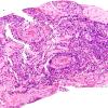 4J2 Lymphoma, B cell & sentinel (Case 4) neoplastic area H&E 4