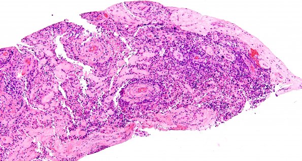 4J2 Lymphoma, B cell & sentinel (Case 4) neoplastic area H&E 4