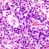 4J3 Lymphoma, B cell & sentinel (Case 4) neoplastic area H&E 1