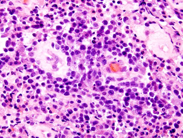 4J3 Lymphoma, B cell & sentinel (Case 4) neoplastic area H&E 1