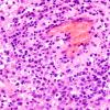 4J4 Lymphoma, B cell & sentinel (Case 4) neoplastic area H&E 5