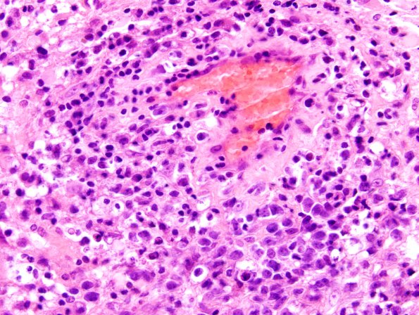 4J4 Lymphoma, B cell & sentinel (Case 4) neoplastic area H&E 5