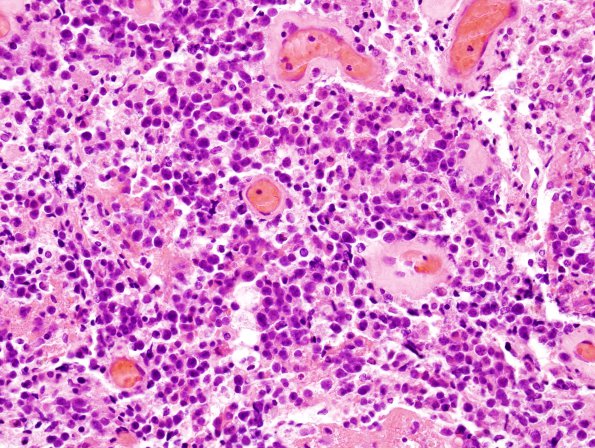 4J5 Lymphoma, B cell & sentinel (Case 4) neoplastic area H&E 8