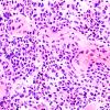 4J6 Lymphoma, B cell & sentinel (Case 4) neoplastic area H&E 9