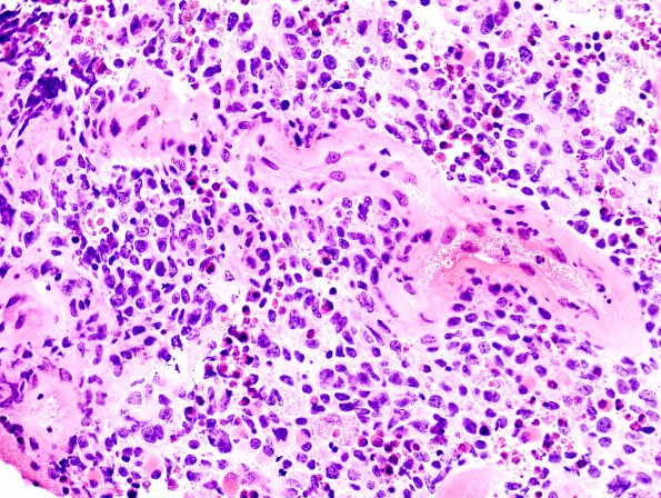 4J6 Lymphoma, B cell & sentinel (Case 4) neoplastic area H&E 9