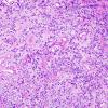 4K Lymphoma, B cell & sentinel (Case 4) neoplastic area LFB-PAS